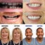 Smile Teeth Fake Braces Teeth Veneer Silica Gel False Teeth Denture Oral Care Carousel 2