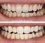 Teeth Whitening in clinic - Christchurch Carousel 7