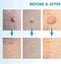 Skin Tag Remover 2-in-1 Tool Kit i2367LB0 Carousel 9