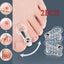 2pcs Bunion Hallux Valgus Toe Spreader Separator Thumb Finger Correction Tool Carousel 2