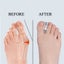 2pcs Bunion Hallux Valgus Toe Spreader Separator Thumb Finger Correction Tool Carousel 1