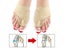 Toe Corrector Orthotics Feet Foot Care Bone Thumb Adjuster Correction Soft Carousel 3
