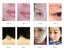 laser picosecond pen for spot removal, tattoo washing, machine for eyebrow washi Carousel 11