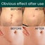 Silicone Scar Sheets Carousel 5