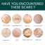 Silicone Scar Sheets Carousel 9