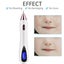 Laser Plasma Pen Tattoo Mole Freckle Spot Mole Tag Removal Skin Beauty Machine Carousel 4