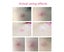 Hydrocolloid Acne Pimple Patch 180 Patches, Acne Pimple Master Patch, Carousel 5