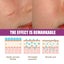 Stretch Mark Surgery Injury Acne Scar Removal Cream Carousel 8