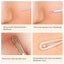 5pcs Professional Acne Blackhead Remover Pimple Comedone Extractor Kit Carousel 6