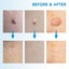 Skin Tag Remover Device Kit Carousel 16