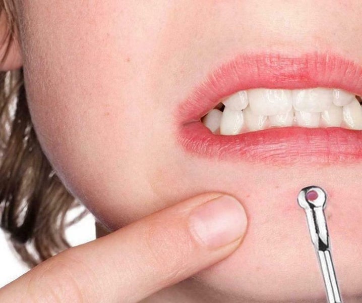 Blackhead Acne Pimple Remover Tool Kit Spot Comedone Extractor 4PCS Carousel 4