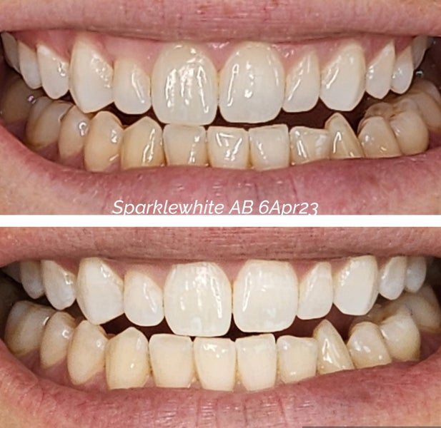 Teeth Whitening in clinic - Christchurch Carousel 7