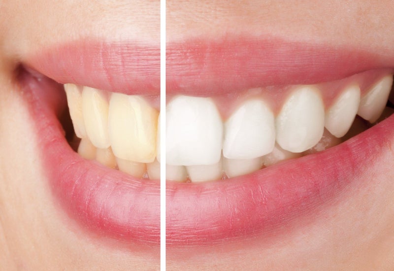 Teeth Whitening in clinic - Christchurch Carousel 1