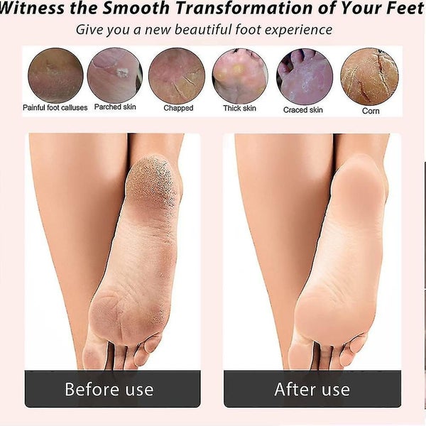 Foot Rasp Stainless Steel Pedicure Foot Care Tool ,eliminate Feet Cracked Dead T Carousel 5