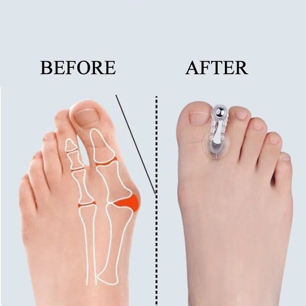 2pcs Bunion Hallux Valgus Toe Spreader Separator Thumb Finger Correction Tool Carousel 1