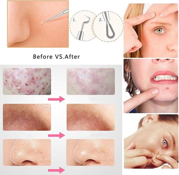 5 Pack Blackhead Remover Kit Pimple Tool Set For Acne Treatment Carousel 5