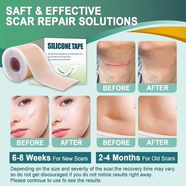 Silicone Scar Sheets Carousel 2