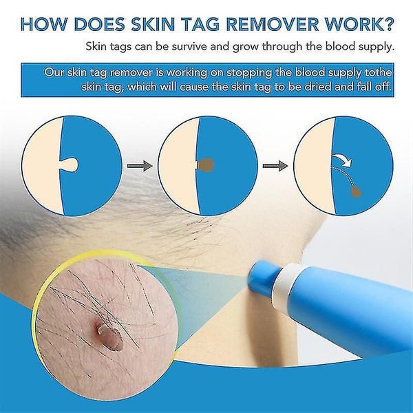 Automatic Skin Tag Remover Kit Label Tape Home Double Headed Wart Removal Tool Carousel 2