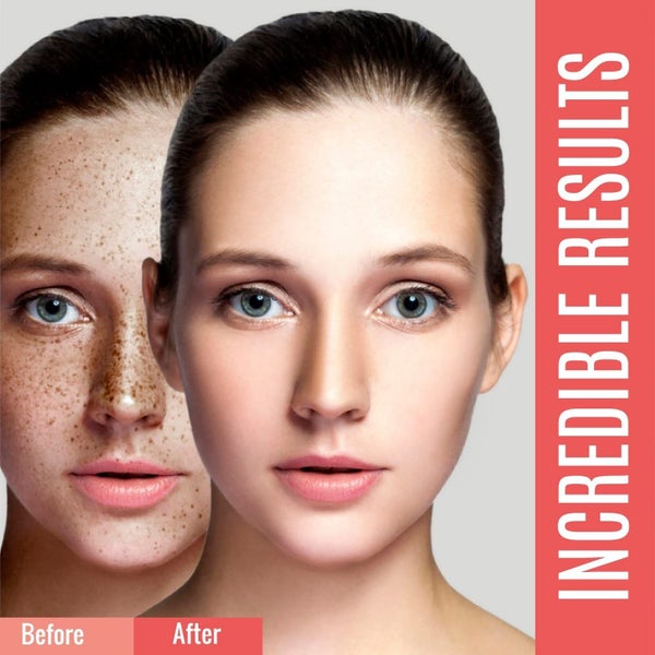 Dark Spot Corrector For Face and Body, Hyperpigmentation Treatment Uneven SKIN62863859842947113