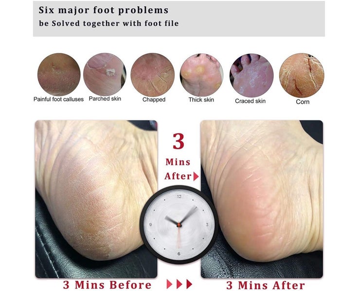 Perfect Wet & Dry Foot File, Callous Remover for Feet, Hard and Dead Skin - R Carousel 5