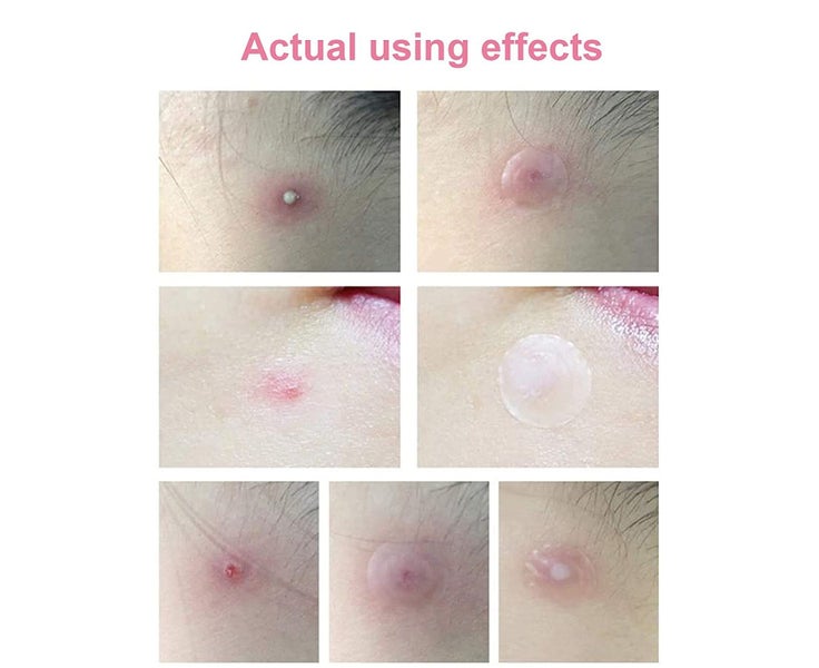 Hydrocolloid Acne Pimple Patch 180 Patches, Acne Pimple Master Patch, Carousel 5