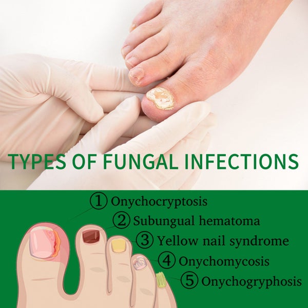 Ginger Nail Fungus Treatment Liquid Anti Fungal Growth Finger Toe Repair Carousel 2