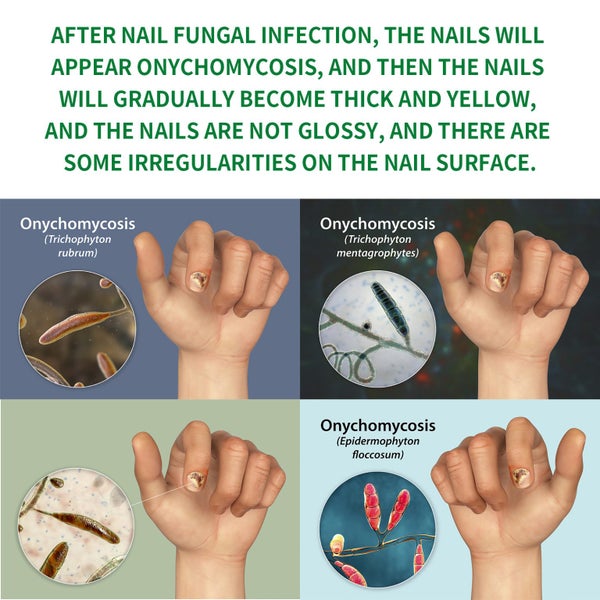 Ginger Nail Fungus Treatment Liquid Anti Fungal Growth Finger Toe Repair Carousel 8