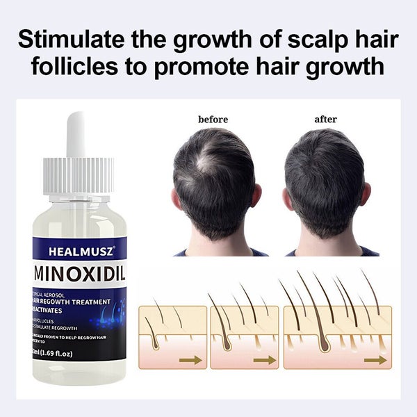 Minoxidil 5% Extra Strength Hair Regrowth Treatment, 100mls - Two Month Supply62863229903745113