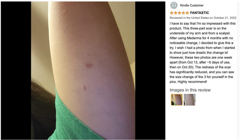 Silicone Scar Sheets, Silicone Scar Tape 4cm x 1.5m64192830484097113