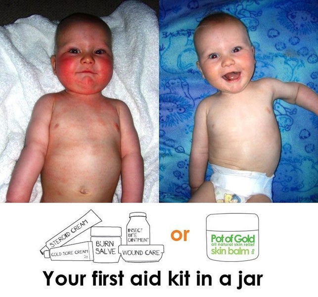 Pot of Gold skin balm 15g for urine scald & rash Carousel 1