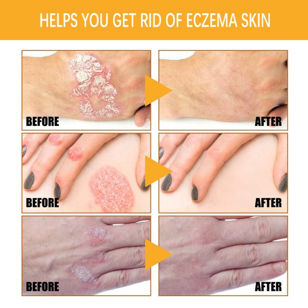 Bee Venom Psoriasis Cream (Auckland Stock) Carousel 8