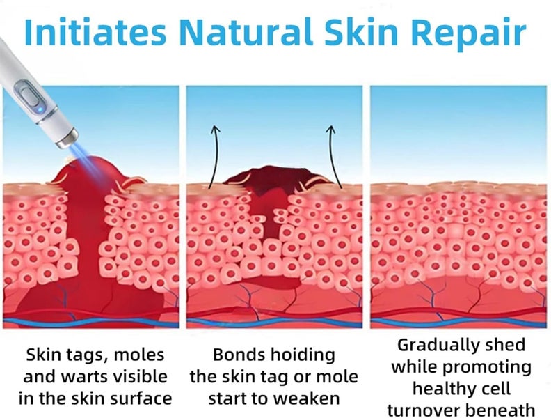 2-Pack Wart Removal Pen, Portable Mole & Dark Spot Remover for Women Carousel 2