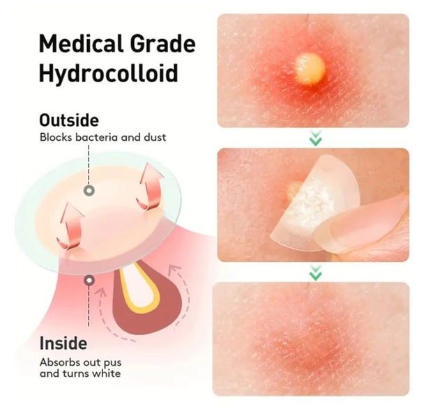 Hydrocolloid Acne Patches 144pcs Pimple Spot #EG228 Carousel 4