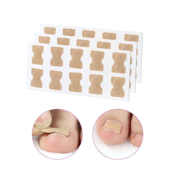 100PCS Glue Free Toenail Toe Ingrown Nail Correction Patch Sticker Foot Care Carousel 1