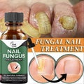 Nail Fungus Treatment Essence Serum Care Hand and Foot Care Removal Repair Gel