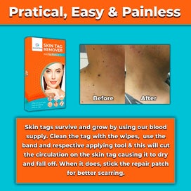Listing 2 of 7 for #1 NEW SKIN TAG REMOVAL KIT PAINLESS REMOVER FAST EASY SAFE MOLE WART SPOT TAGS