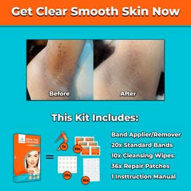Listing 3 of 7 for #1 NEW SKIN TAG REMOVAL KIT PAINLESS REMOVER FAST EASY SAFE MOLE WART SPOT TAGS