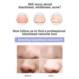 Listing 4 of 5 for Blackhead Remover Vacuum Usb Rechargeable Acne Comedone Whitehead