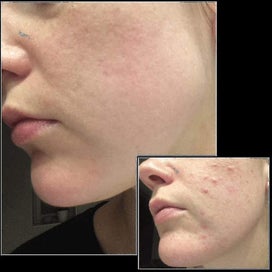 Listing 4 of 4 for Adjustable Microneedle Derma Stamp For Face Skin Acne Scar Repair And Hair Growt