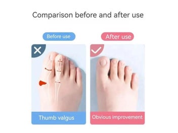 Listing 5 of 9 for 2 Pairs Flexible Foot Orthotic Compact And Exquisite Appearance Relief From