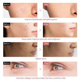 Listing 5 of 5 for NNEOBA 7 Colors LED Facial Mask - Wireless Face Care Treatment