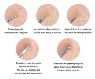 Listing 6 of 6 for 4PCS Blackhead Remover Pimple Comedone Extractor Tool Acne Kit