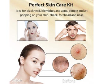 Listing 4 of 8 for 5-Piece Set Blackheads Blemish Removing Acne Whitehead Removal Kit Pimple E