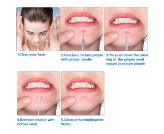 Listing 7 of 8 for 5-Piece Set Blackheads Blemish Removing Acne Whitehead Removal Kit Pimple E
