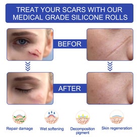 Listing 6 of 20 for Silicone Scar Sheets Silicone Scar Tape Roll Scar Silicone Strips 4cm x 3m