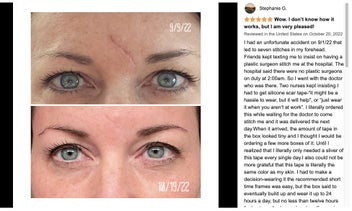 Listing 14 of 20 for Silicone Scar Sheets Silicone Scar Tape Roll Scar Silicone Strips 4cm x 3m