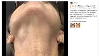 Listing 16 of 20 for Silicone Scar Sheets Silicone Scar Tape Roll Scar Silicone Strips 4cm x 3m