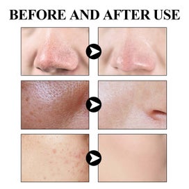 Listing 7 of 9 for Blackhead Removal Pore Tightening Mud Mask