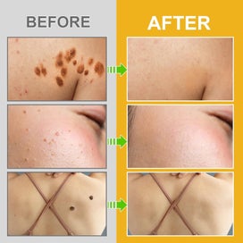 Listing 5 of 8 for 60g Bee-Venom Wart and Tag Remover Bee-Venom Mole & Wart Treatment Cream